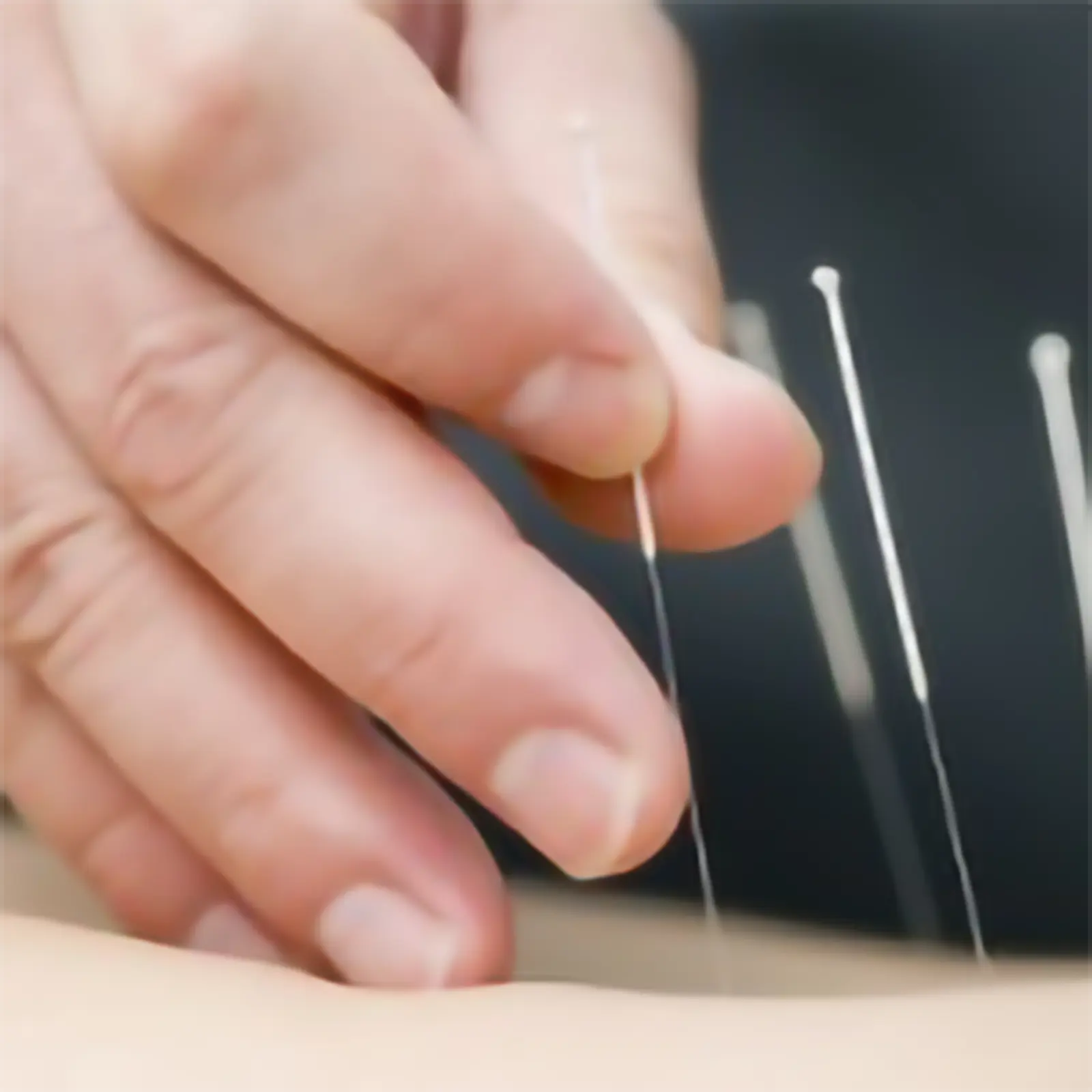 Acupuncture